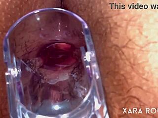 Speculum examination of the anus and the gaping hole